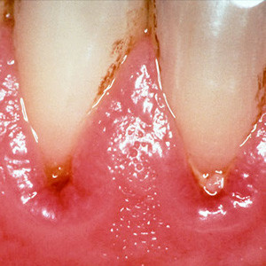 Research indicates there may be a link between poor oral hygiene and stroke risk. Photo courtesy of AJ Cann via CC License.